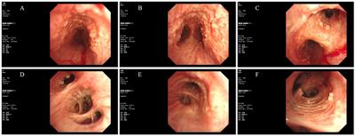 Tracheobronchopathia osteoplastica: a clinical case report of a 63-year-old man